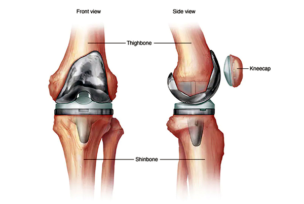 Joint Replacement Surgery