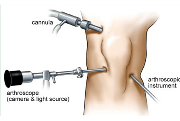 Arthroscopic Surgery