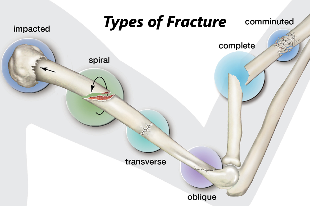 Fracture Management